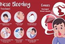 causes-of-nosebleeds-in-heat