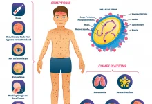 measles-threat-in-bajna-ratlam