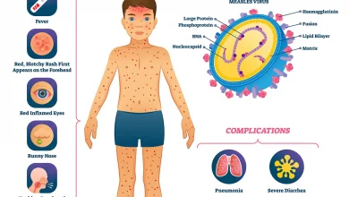 measles-threat-in-bajna-ratlam