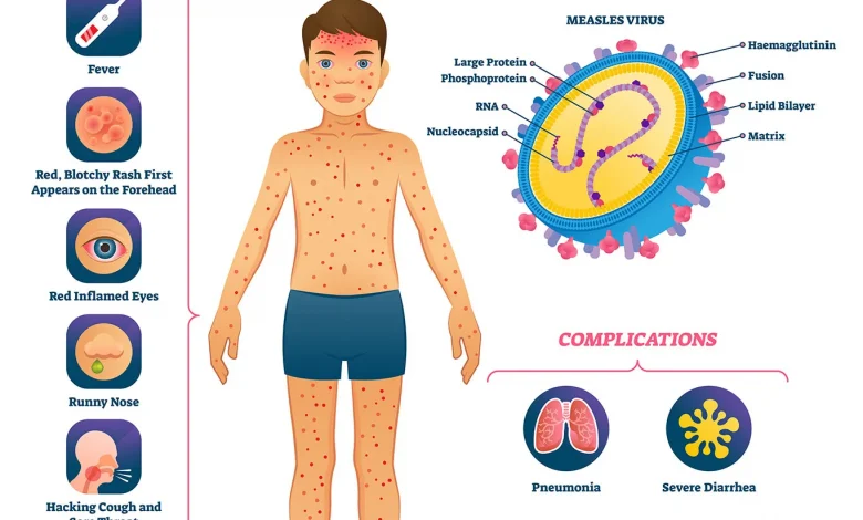 measles-threat-in-bajna-ratlam