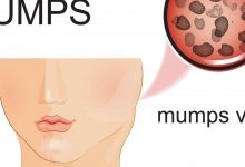 mumps-virus-alert-in-america