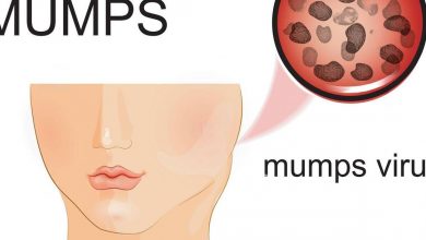 mumps-virus-alert-in-america