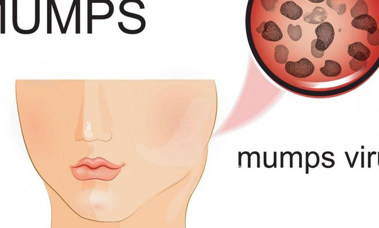 mumps-virus-alert-in-america