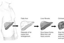 fatty-liver-foods-benefits