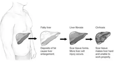 fatty-liver-foods-benefits